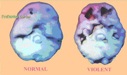 Scan d'un cerveau normal et d'un cerveau violent