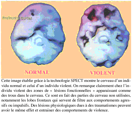 Scan d'un cerveau normal et d'un cerveau violent